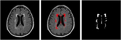 Brain White Matter Hyperintensity Lesion Characterization in T2 Fluid-Attenuated Inversion Recovery Magnetic Resonance Images: Shape, Texture, and Potential Growth